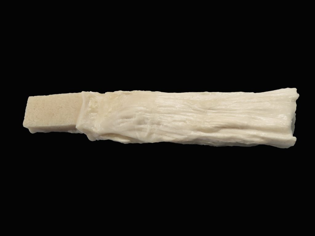 Quadriceps Tendon w/srut