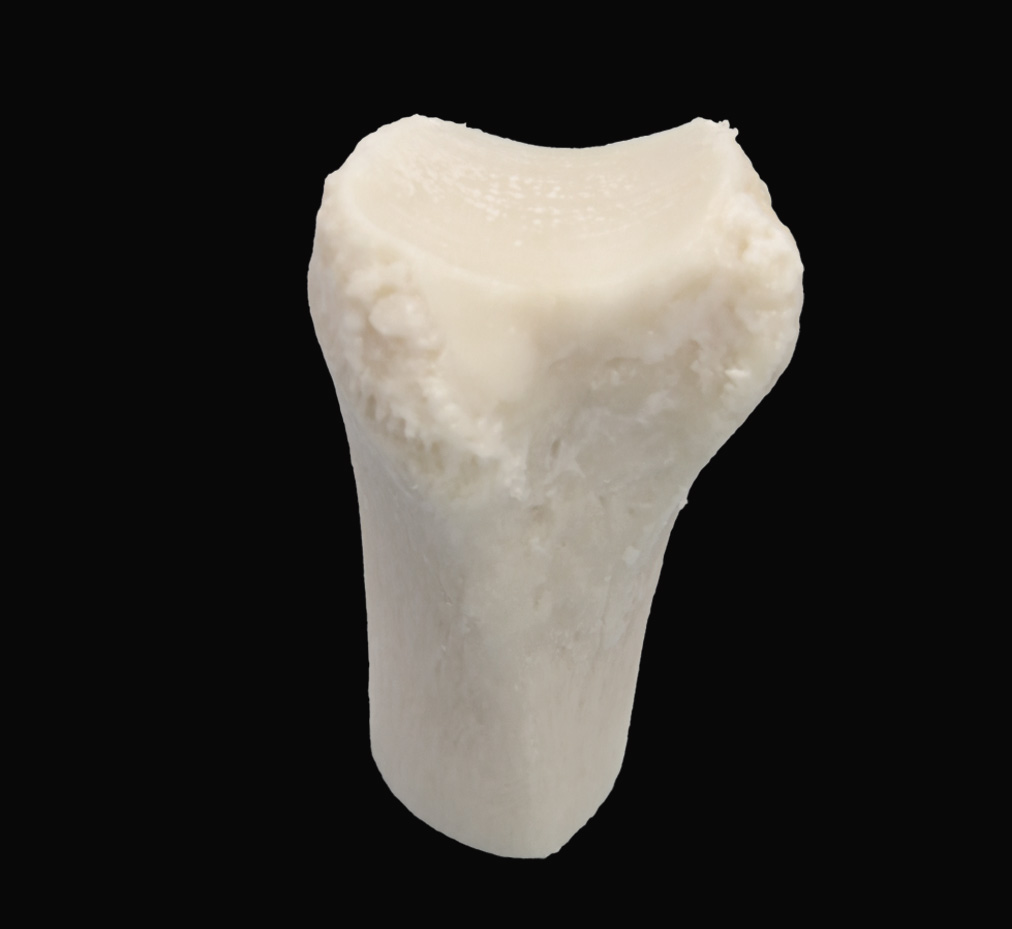 Distal Tibia